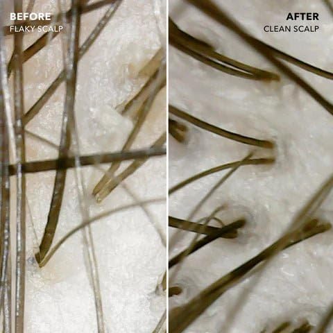 Anti Dandruff Shampoo and Conditioner with 2% Pyrithione Zinc and Stem Cells | Physician Founded for Itchy Scalp | Eliminates Flakes & Fights Dandruff | Color Safe, Sulfate Free, Paraben Free