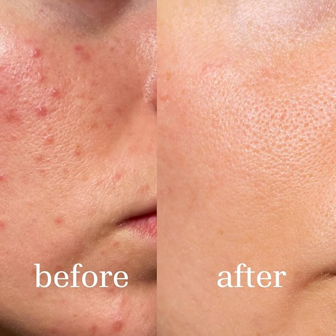 Clear Acne Patches – Pharmacist‑Formulated Hydrocolloid Pimple Stickers with Salicylic Acid & Tea Tree Oil (108 Count, 8 mm & 12 mm) – Invisible, Gentle & Fast‑Acting