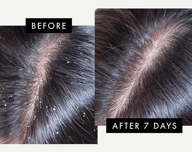 Anti Dandruff Shampoo and Conditioner with 2% Pyrithione Zinc and Stem Cells | Physician Founded for Itchy Scalp | Eliminates Flakes & Fights Dandruff | Color Safe, Sulfate Free, Paraben Free