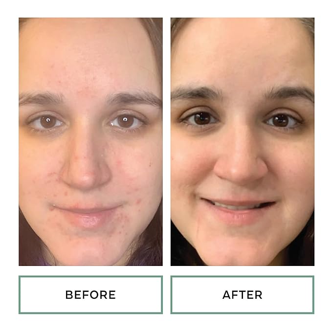 Replenix Gly-Sal Clarifying Acne Pads, 60 Count, Medical-Grade 10% Glycolic Acid & 2% Salicylic Acid Exfoliating Pads for Acne-Prone Skin, Help Clear Blemishes & Refine Pores, Non-Oily