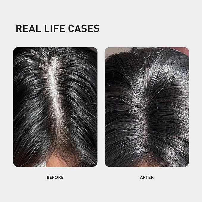 0.5% KINTOR KX-826 Hair Growth Spray,Oil Control Strengthen Hair,Hair Regrowth Products for Women&Men,Basic,240ml