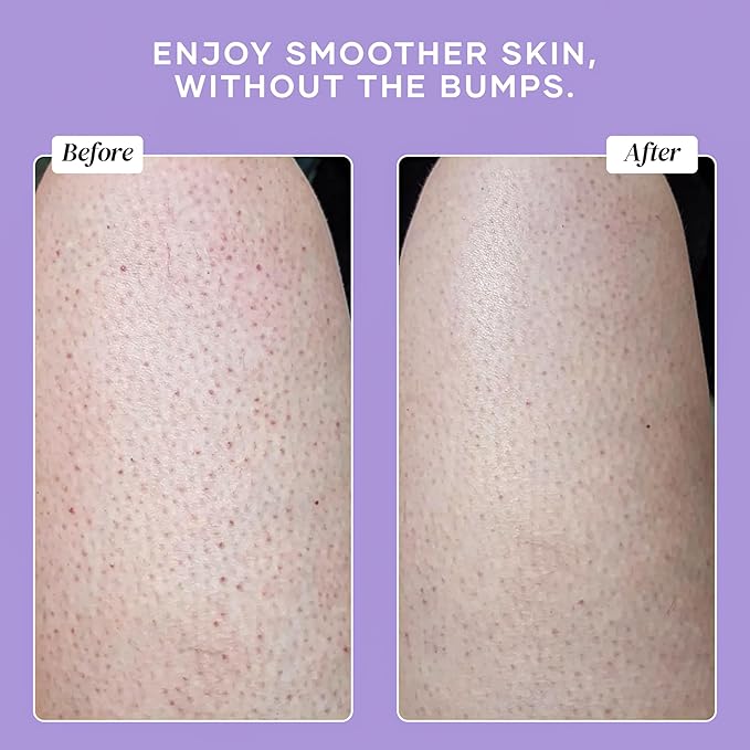 DERMAdoctor KP Bump Eraser Body Scrub with 10% AHAs + PHAs for Keratosis Pilaris, Dry, Rough, and Bumpy Skin, Dermatologist Formulated Exfoliating Body Scrub with Glycolic and Lactic acids - 16 Fl oz