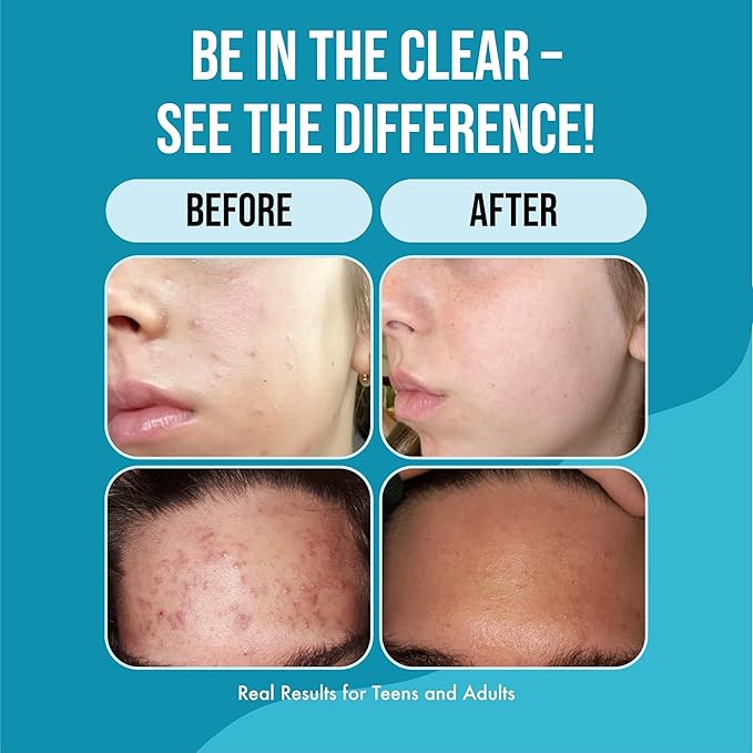 Teenology Teen Shampoo – Avoid Acne Breakouts, Non-Comedogenic, For Dry & Oily Scalps, Sulfate & Paraben Free, Natural Botanical Extracts, for Clear Skin & Healthy Hair, 16 oz – (Mint)