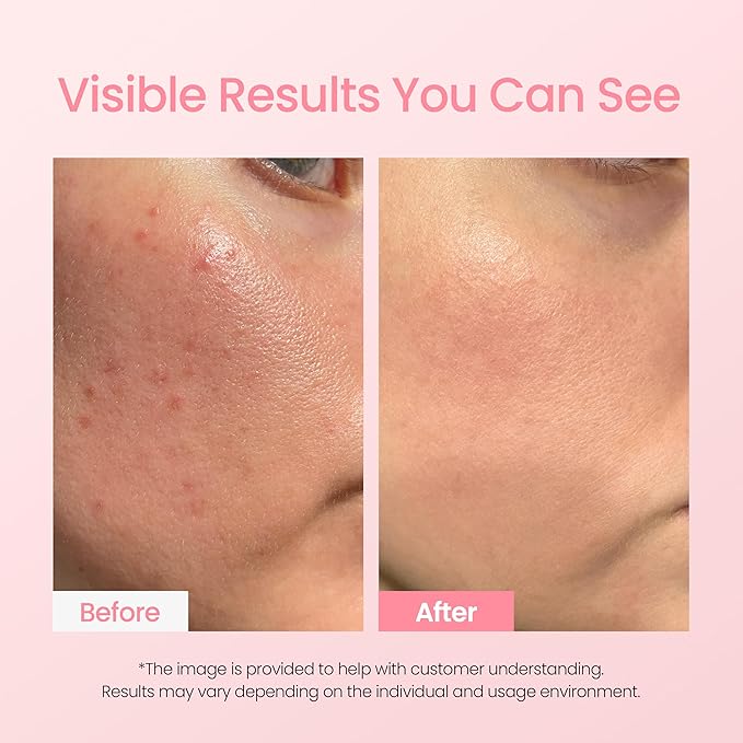 NEOGEN A-Clear Soothing Pink Eraser, Spot Care, Blemish Care, Korean Skin Care, Pink Pimple Drying Power, Calamine Powder, Nighttime Spot for Face and Skin (0.50 Fl Oz)