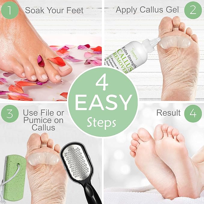 Dr. Entre's Callus Remover Gel Kit for Feet: Foot File, Pumice Stone, 5 Glove Pairs for Gel Application, Spa Kit, Foot Care, Pedicure Tools, Scrubber, 8oz
