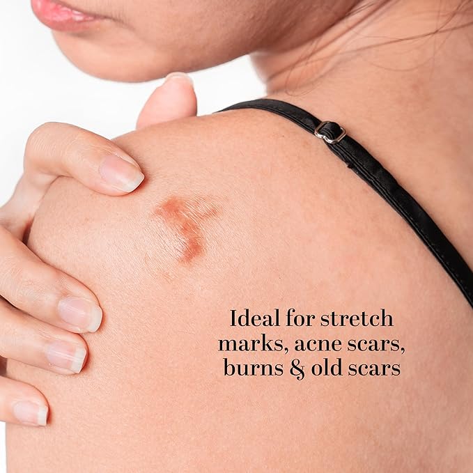 Better Shea Butter Scar Eraser Balm - Cocoa Butter Cream for Stretch Marks and Dark Spots, Burns, Old Scars - Acne Scars - Designed w Zero Synthetic Ingredients, 4 oz