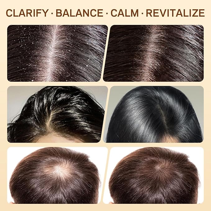 Rice Water Scalp Scrub with Salicylic Acid(BHA), Tea Tree & Rosemary – Gentle Exfoliating Scalp Scrub Shampoo for Dandruff, Removes Buildup, Controls Oil & Refreshes the Scalp, 8.8 oz